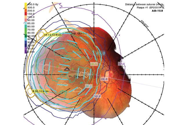 3D Reconstruction of the Eye