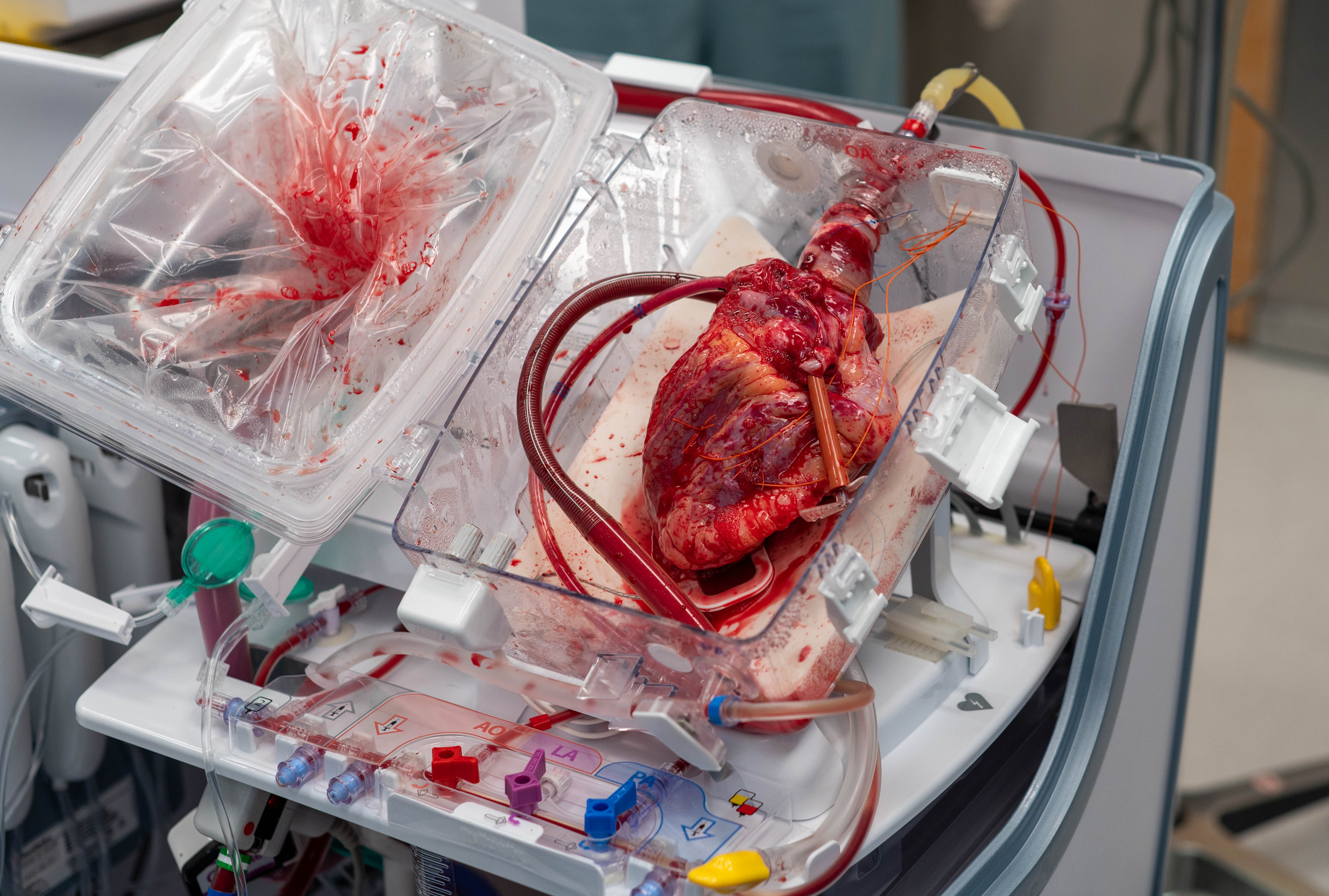 Donor heart on perfusion machine