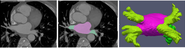 Pretreatment mapping of the left atrium is much quicker with the help of AI. The images show a standard heart CT scan (left), a scan with AI mapping (middle), and a detailed AI map of the left atrium (right).