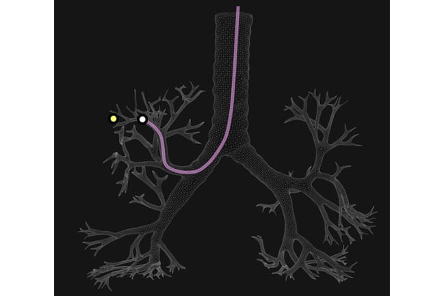 Illustration of a bronchoscope in a lung nodule