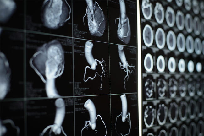 Cardiovascular radiographs lit from behind.