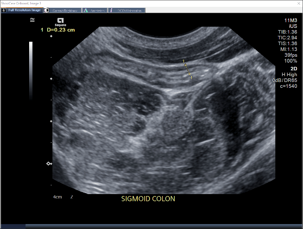 Ultrasound image of the sigmoid colon